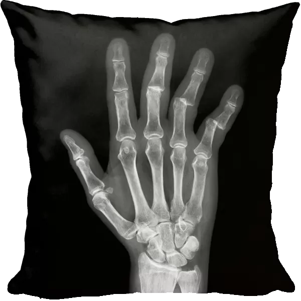 Dislocated fingers, X-ray C017  /  7754