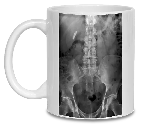 Gallstones, X-ray C017  /  7860