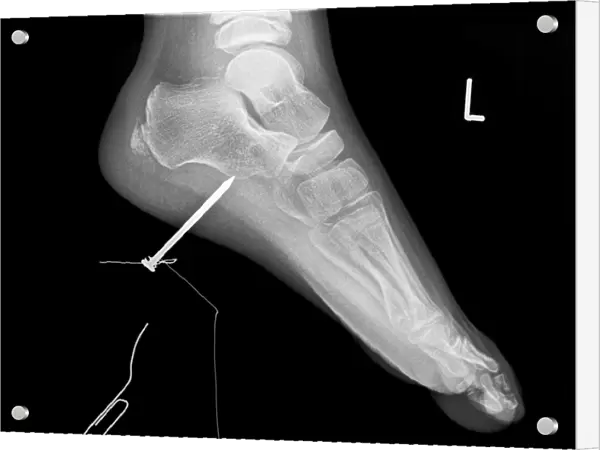 Nail in foot, X-ray C017  /  7980