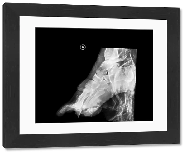 Crushed right foot, X-ray C017  /  8012