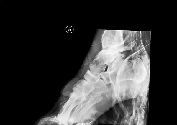 Crushed right foot, X-ray C017  /  8012