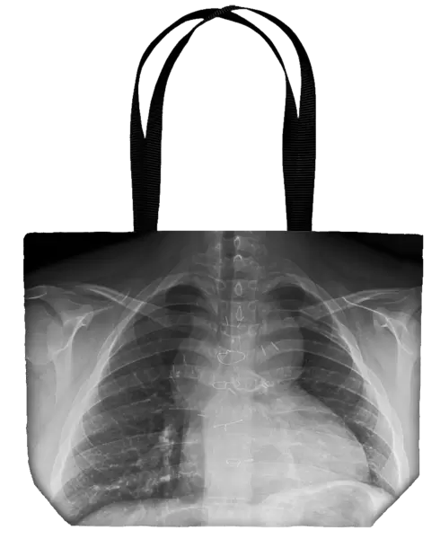 Congenital heart disease, X-ray C017  /  8020