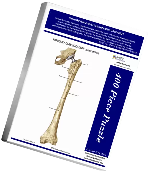 Paprosky femur defect classification C016  /  6621