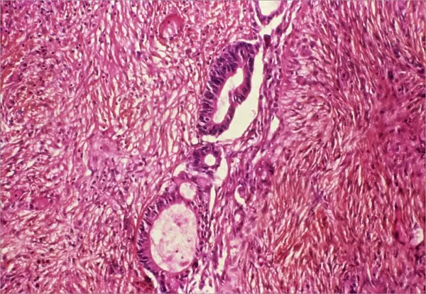 Ovarian cancer, light micrograph C015  /  7103