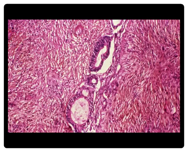 Ovarian cancer, light micrograph C015  /  7103