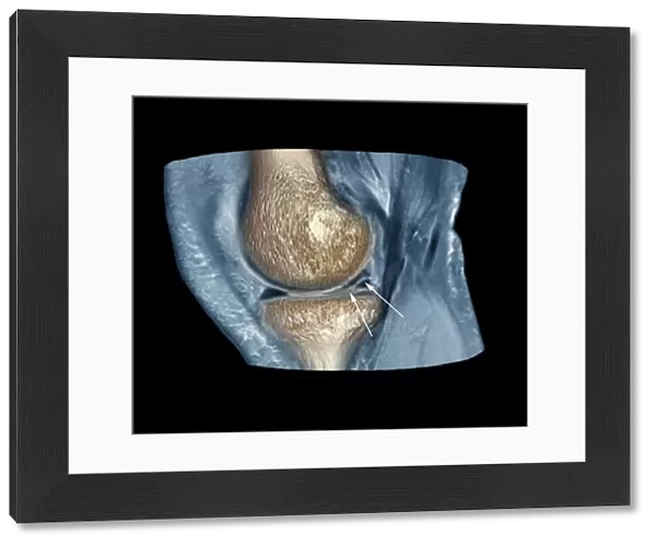 Knee injury, 3D CT scan C018  /  0639