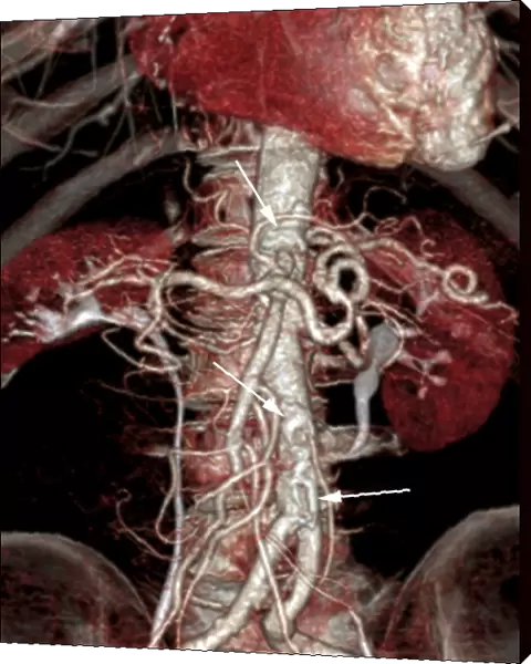 Atherosclerosis, 3D CT scan C016  /  6540