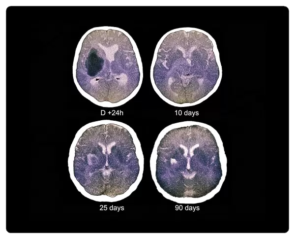 Stroke, CT scans