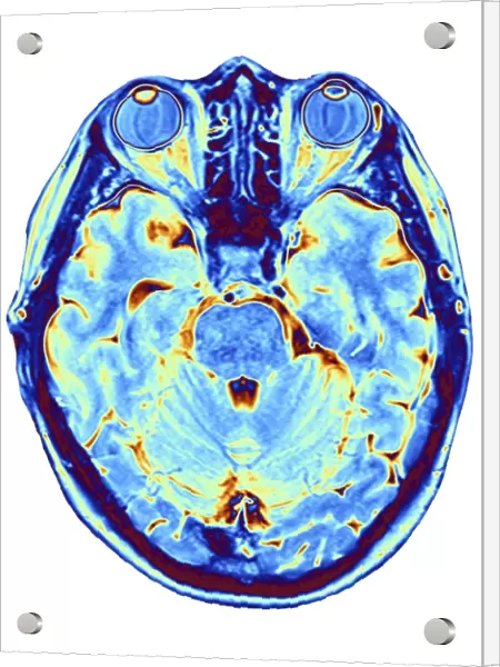 MRI brain scan F006  /  9208