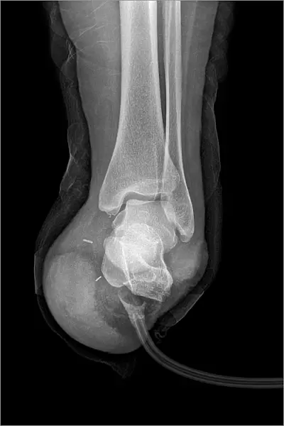 Amputated foot, X-ray C017  /  7386