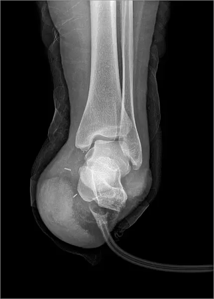 Amputated foot, X-ray C017  /  7386