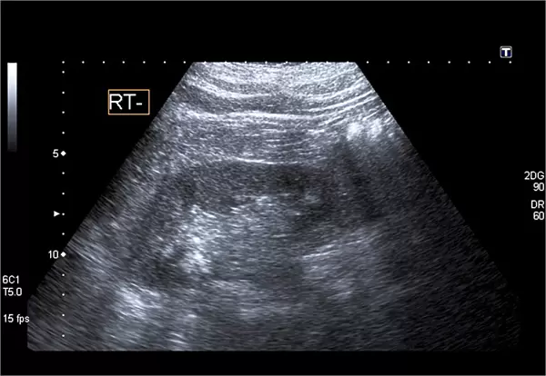 Bladder stones, ultrasound scan C017  /  7263
