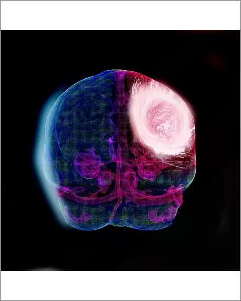 Brain tumour, DTI modelling C017  /  7060