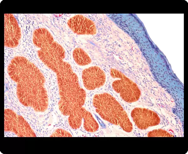 Skin cancer, light micrograph F005  /  6061