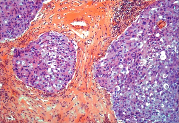 Breast cancer, light micrograph F005  /  6079