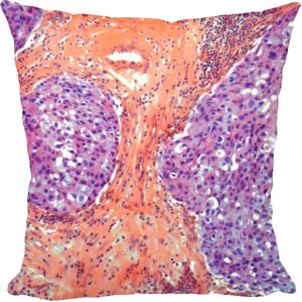 Breast cancer, light micrograph F005  /  6079