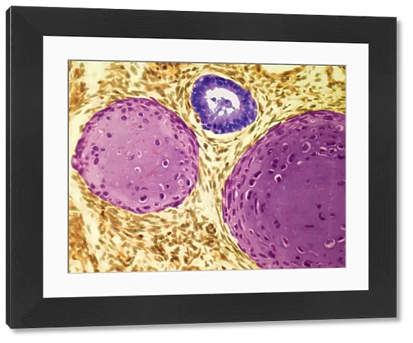 Testicular cancer, light micrograph F005  /  6063