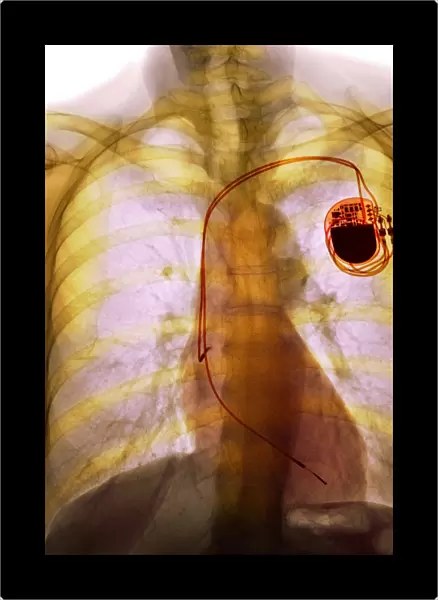 Dual chamber pacemaker, X-ray F008  /  3508