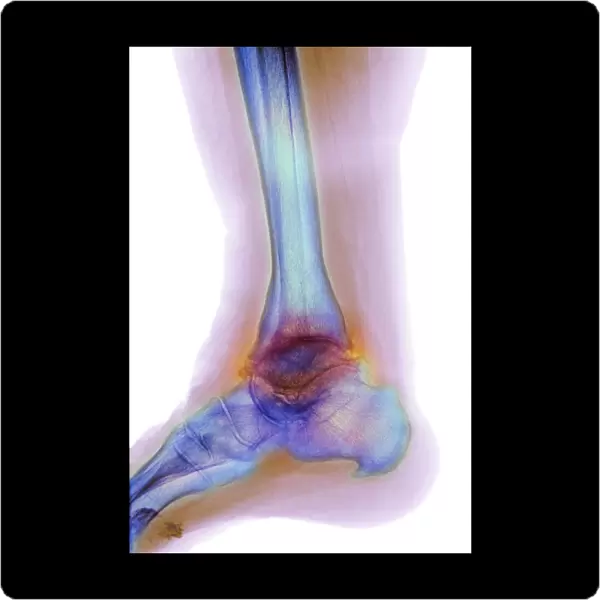 Osteoarthritis of the ankle, X-ray F008  /  3483