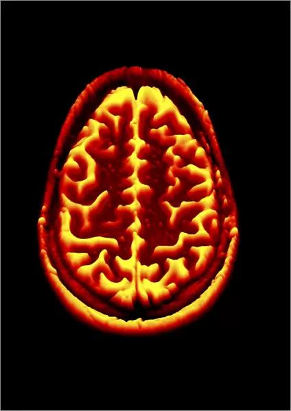 Brain scan, MRI scan, heightmap F006  /  7081