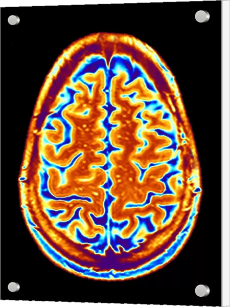 Brain scan, MRI scan F006  /  4610