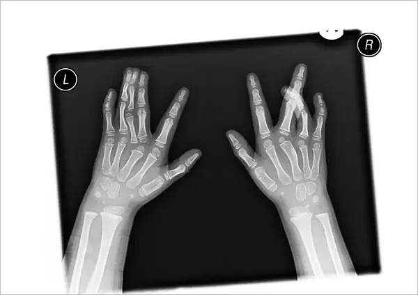 Deformed hands, X-ray C017  /  7561