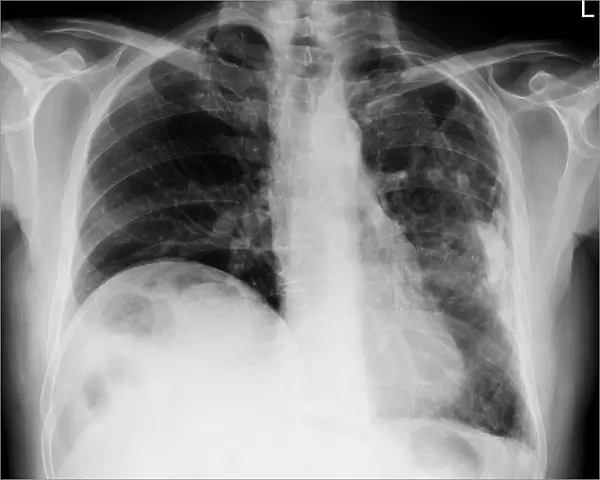 Lung disease, X-ray C017  /  7568