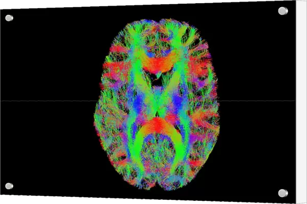 Brain fibres, tract density imaging C017  /  7039