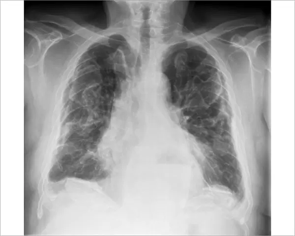 Asbestosis, X-ray C017  /  7143