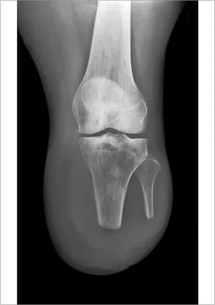 Amputated lower leg, X-ray C017  /  7644