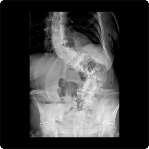 Scoliosis of the spine, X-ray C017  /  7167