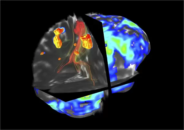 Brain tumour, fMRI and tractography C017  /  7102
