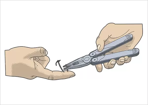 Digital illustration of cutting off barbed end of fish hook embedded in finger using pair of pliers