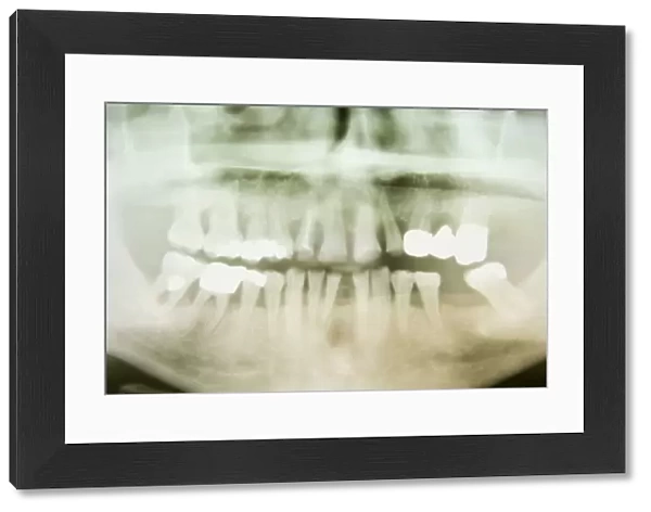 X-ray image of a human jaw with treated teeth, Germany, Europe