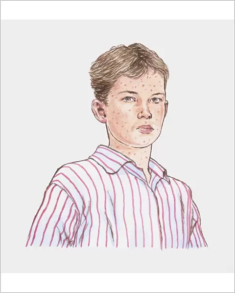 Illustration of teenage boy with chickenpox