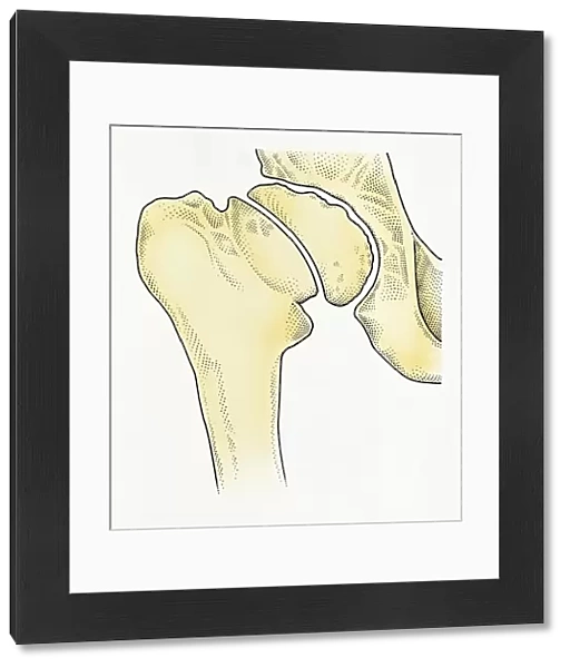 Digital illustration showing degeneration of hip joint known as Perthes disease