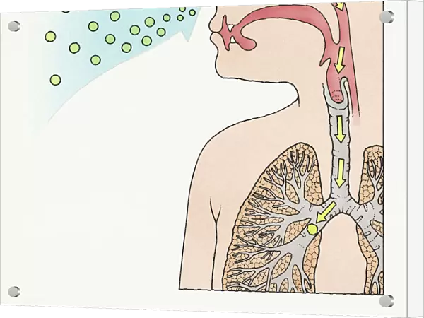 A diagram showing aspergilloma affecting human lung