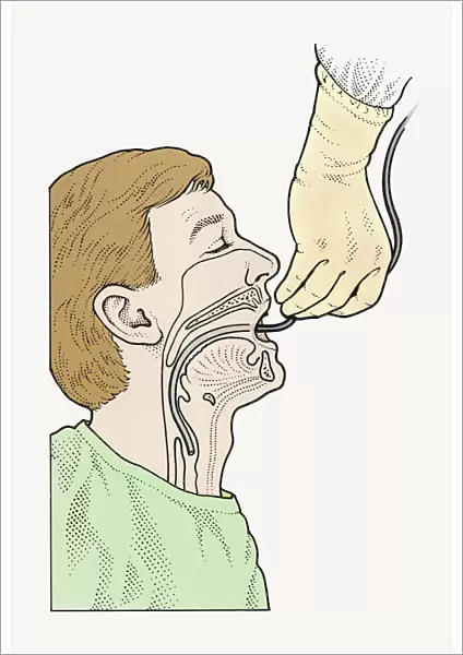 Diagram showing bronchoscope being inserted into patients throat