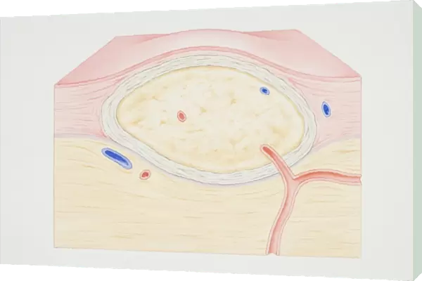 Cross-section diagram of a non-cancerous tumour including a fibrous capsule, tissue layer and blood vessel
