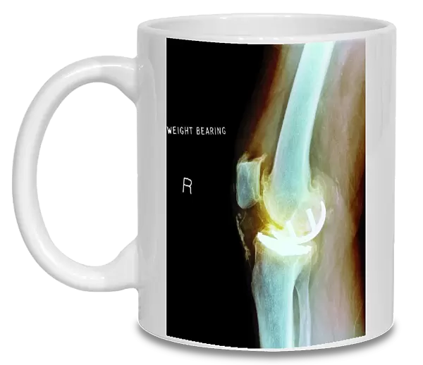 Osteoarthritis of the knee, X-ray