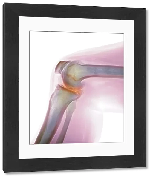 Arthritis of the knee, X-ray