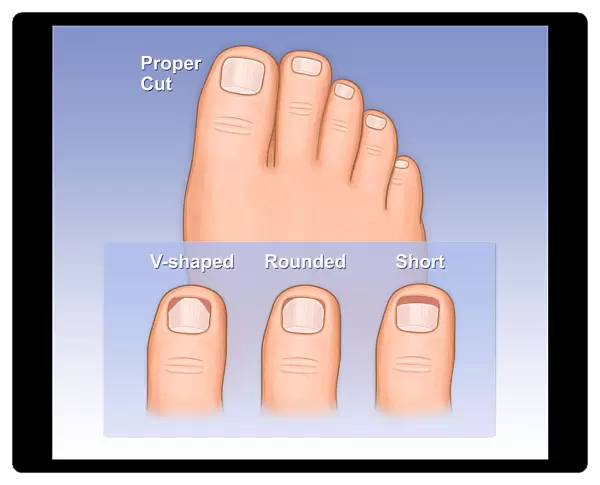 Showing a proper way to cut toe nails versus and improper way, shown as a rounded cut