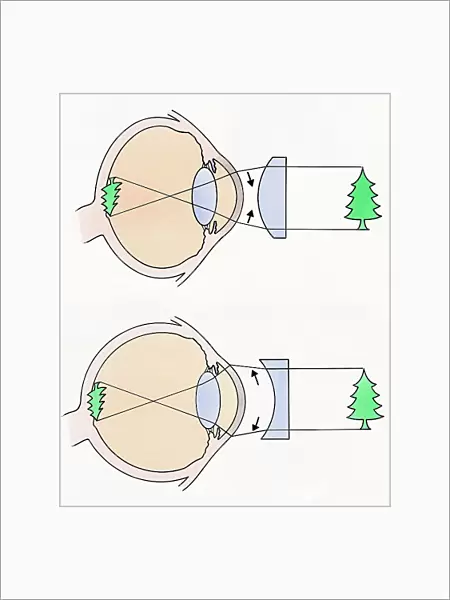 Cross section illustrations of human eyes with concave and concave lenses looking at green tree