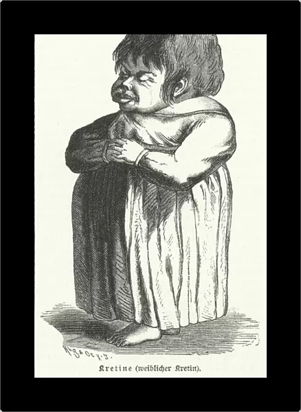 Cretin, woman suffering from congenital iodine deficiency syndome (engraving)