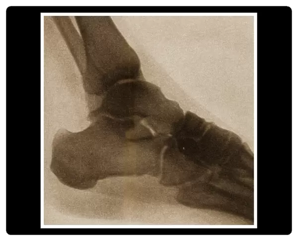 X Ray of an ankle c. 1890