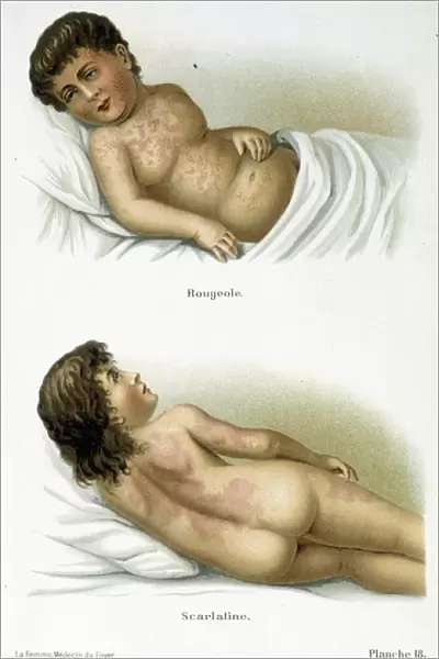 Scarlet fever and measles - 19th century