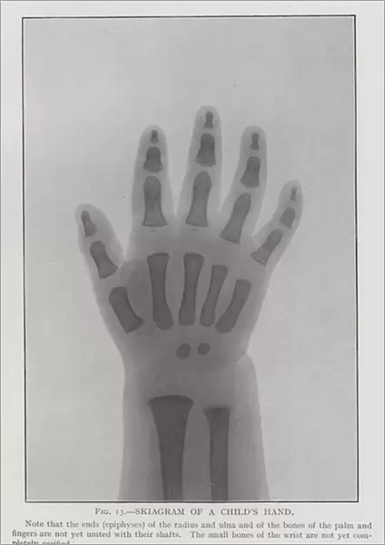 Skiagram of a Childs Hand (b  /  w photo)