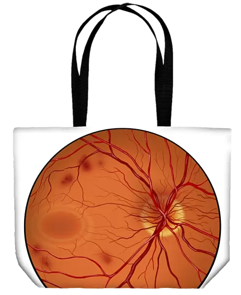 Retina with neovascularization