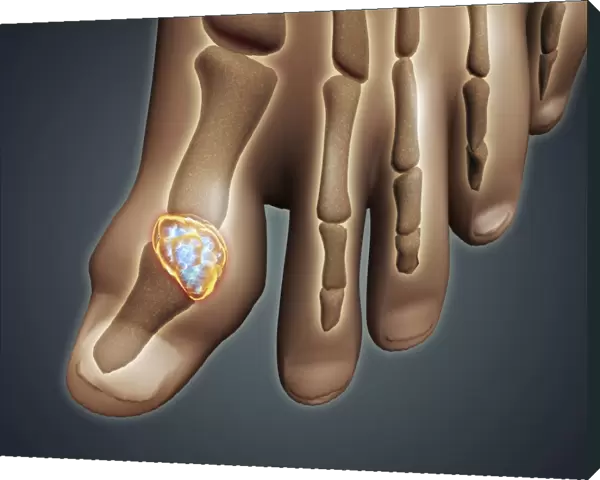 Conceptual image of gout in the big toe