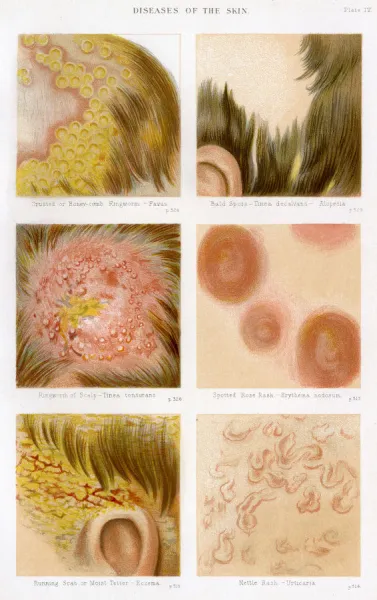 Diseases of the Skin Plate 4. Crusted or Honeycomb Ringworm #18072791 Diseases of the Skin Plate 4. Crusted or Honeycomb Ringworm #18072791